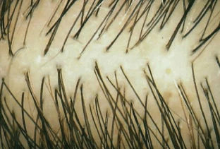 Antes de Folicerin: cabello con signos de pérdida.