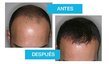 Resultados antes y después de Profolan: detiene la caída del cabello y aumenta la densidad capilar.