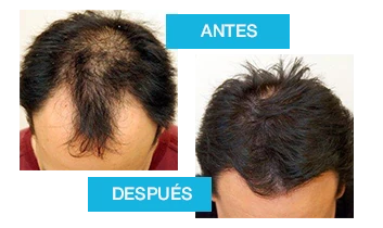 Transformación capilar con Profolan: notable mejora en el crecimiento y densidad del cabello.